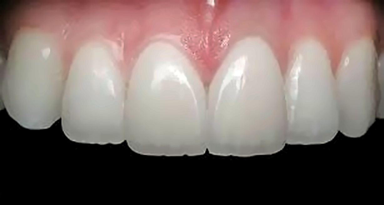 Close-up de dentes anteriores com acabamento estetico