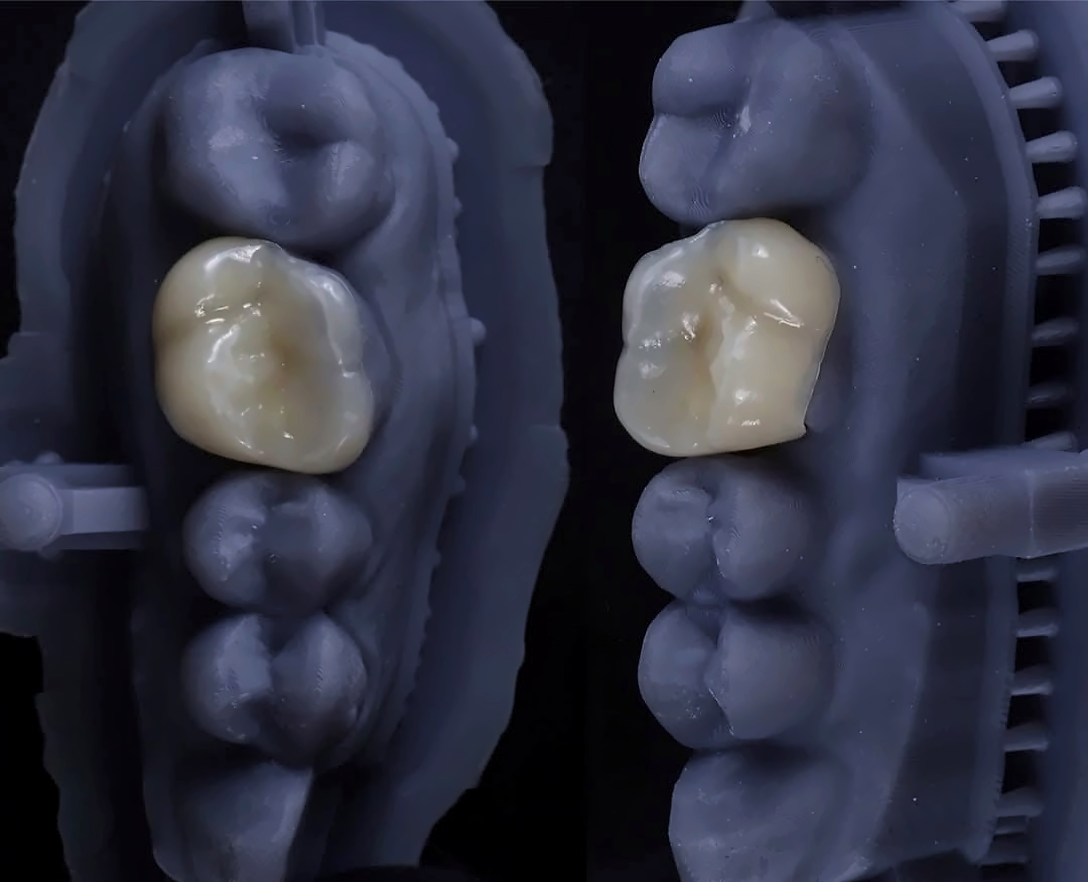 Coroas posicionadas sobre modelo odontologico